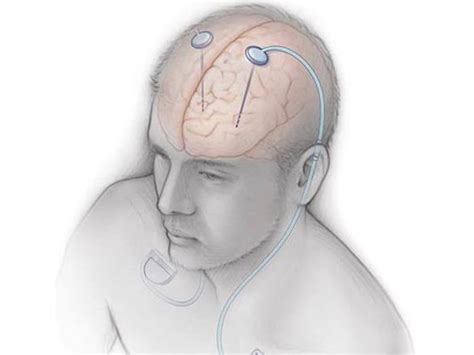 Doctors of Ganga Ram Hospital performs rare surgery for patient ...