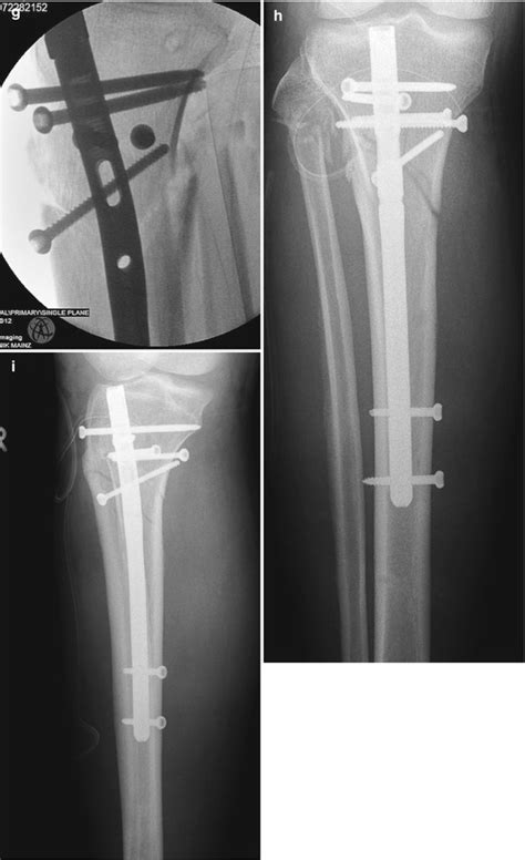 Proximal Tibia 的图像结果