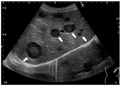 Liver Cancer Ultrasound