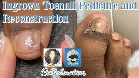 Full Toenail Extraction 的图像结果