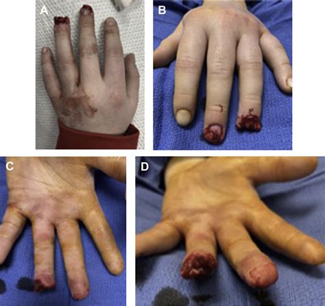 Primary Management of Nail Bed and Fingertip Injuries in the Emergency ...