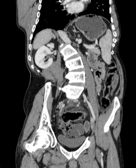 Image result for Perforated Appendix