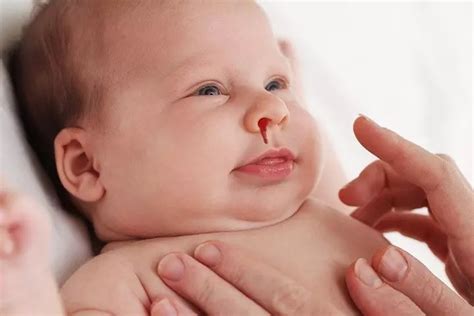 孕期流鼻血是怎么回事？怎样预防流鼻血 - 知乎