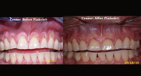 Chao Pinhole® Surgical Technique San Diego, La Jolla | Gum Recession Treatment | Gum Rejuvenation