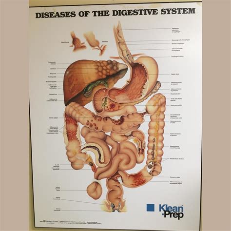 Digestive System Diseases 的图像结果