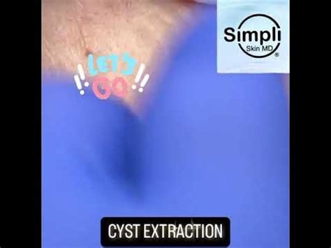 Image result for Cyst Extraction Videos