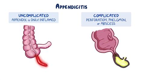 Image result for Different Types of Appendicitis
