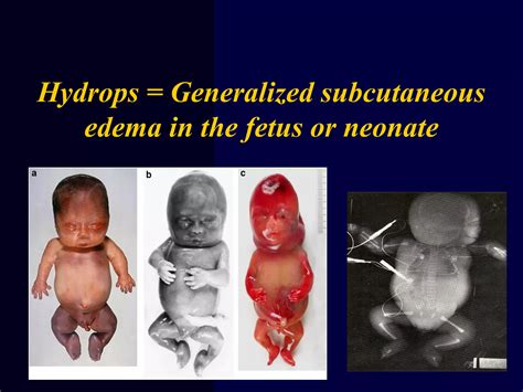 Hydrops fetails for undergranuate | PPT
