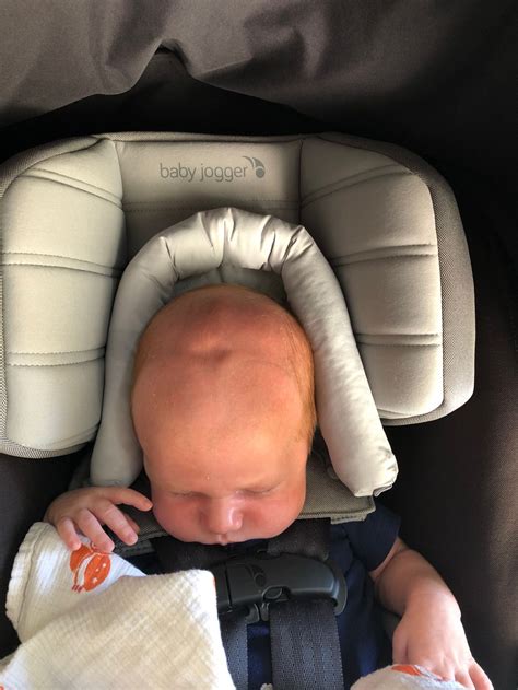 Sunken Eyes In Babies