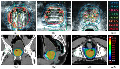 Dosimetric Comparison of VMAT Alone and VMAT with HDR Brachytherapy ...
