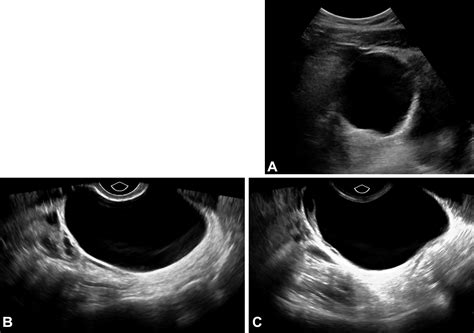 Benign-appearing Incidental Adnexal Cysts at US, CT, and MRI: Putting the ACR, O-RADS, and SRU ...