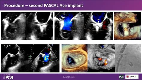 Image result for Pascal OP Surgery