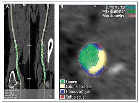 Multi-Modality Imaging of Atheromatous Plaques in Peripheral Arterial ...