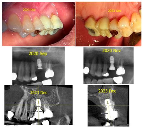 Prosthetic Management of Peri-Implant Mucositis via CRD Optimization: A ...