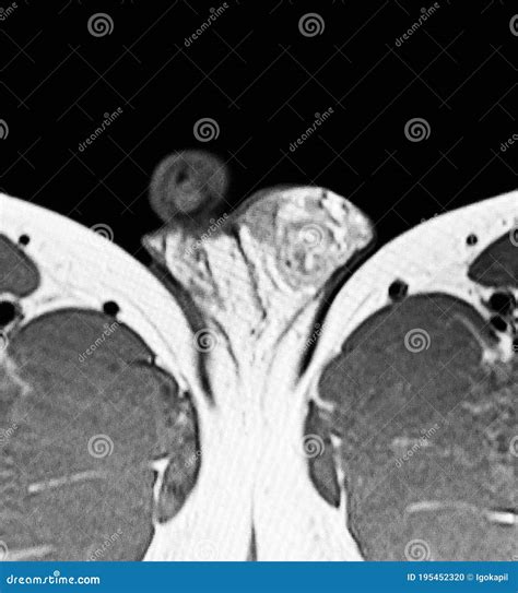 Pelvic Mri Diagnostic Varicocele Pathology Man Stock Photo - Image of ...