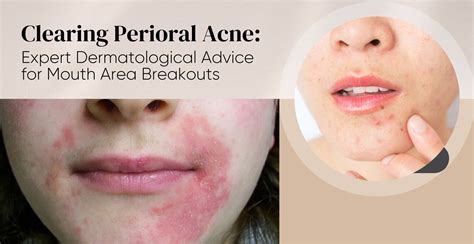 Hormonal Acne Around Mouth