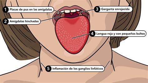 Síntomas de la escarlatina | Group A Strep | CDC