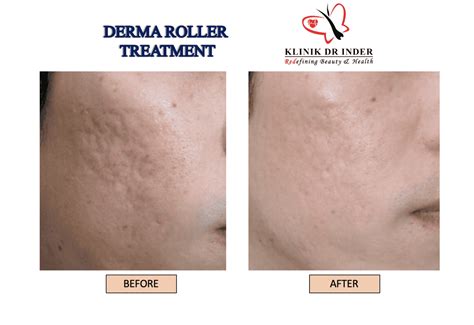 Derma Roller Treatment - Whitening Skin - Aethetic Clinic Malaysia