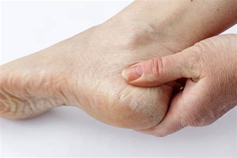 How to get rid of dry hands and feet – Derma Essentia