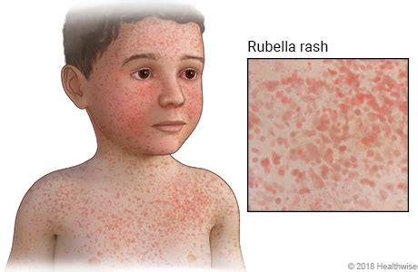 Bildergebnis für rubella symptoms