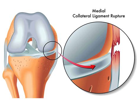 What on earth is a knee MCL sprain? (and how to get rid of it) – Injury ...
