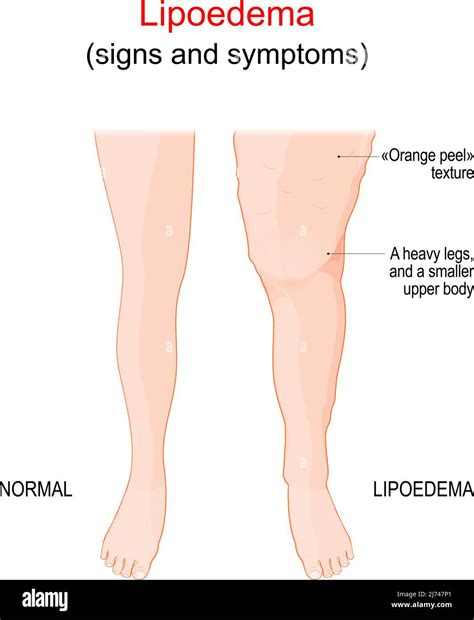 Lipedema Or Just Fat Legs