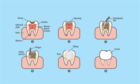 What is Endodontics? – Loock Dental