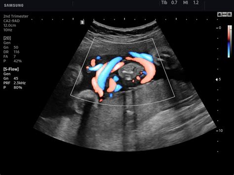 Bildergebnis für umbilical cord abnormalities ultrasound