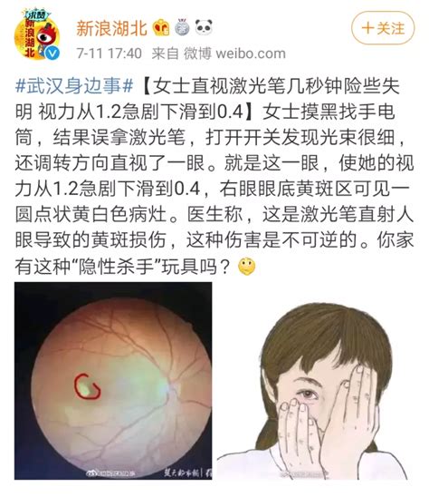 激光笔成伤眼“凶器”，柳人医眼科医生发出警示：其损伤不可逆，切勿让孩子轻易接触-柳州市人民医院