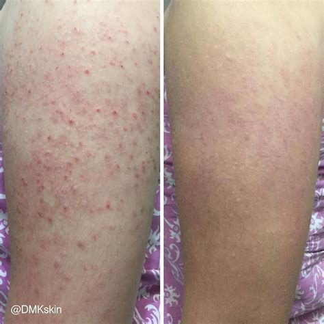 Tanning Bed Rash On Buttocks