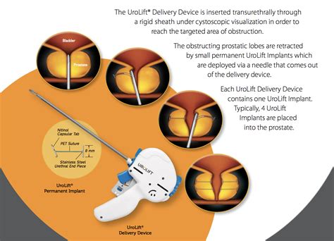 Image result for Urolift Recovery Process