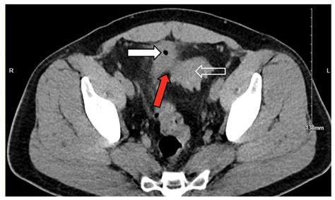 Comparison of Open Versus Minimally Invasive Repair of Colovesical ...