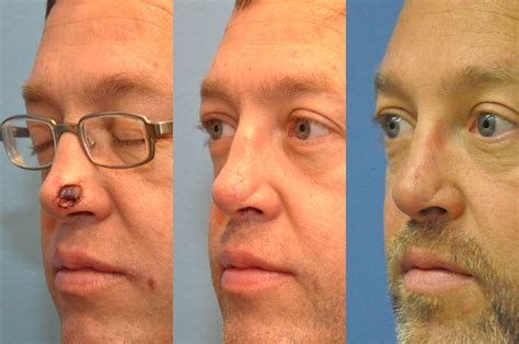This client sought out Dr. LeBeau's expertise for reconstruction of his nasal defect following ...
