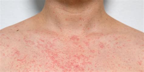 What Is Heat Rash? Dermatologists Explain the Causes | PS Beauty