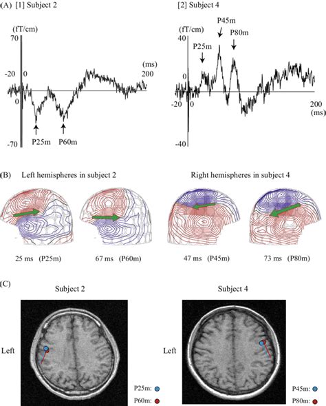 Image result for Contralateral Hemisphere
