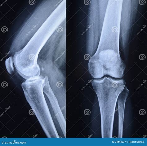 Normal Knee X-Ray Royalty Free Stock Photography - Image: 34444037