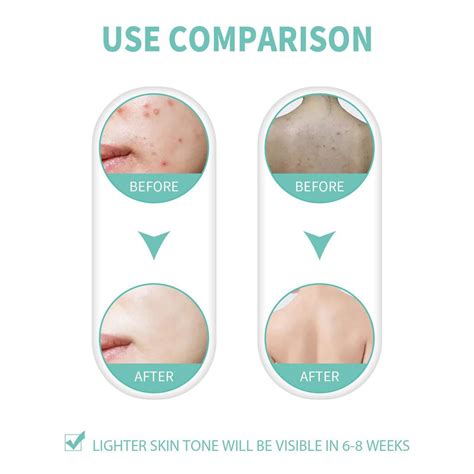 Ingrown Hair On Balls Ingrown Hair Care Ball Bump Care For Bikini Area