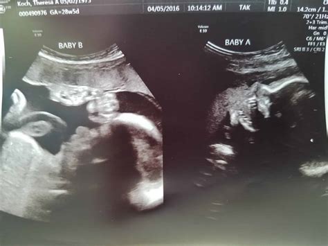 28 Week Fetus Ultrasound