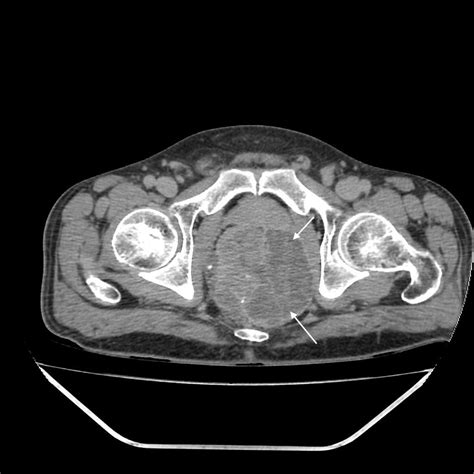 Perianal Abscess Drainage
