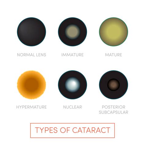 Types Of Cataracts
