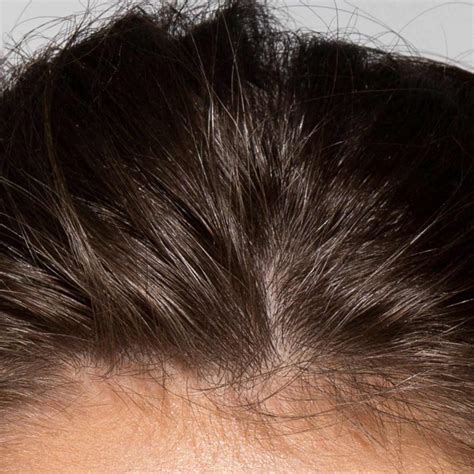 How to avoid hair fall in monsoon – mCaffeine