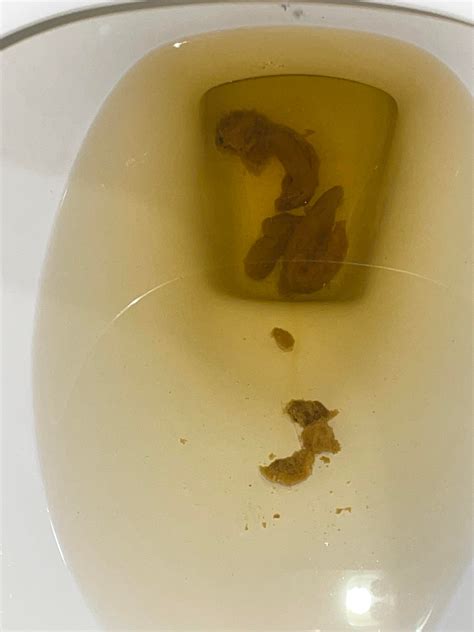 Image result for Colon Cancer Poop