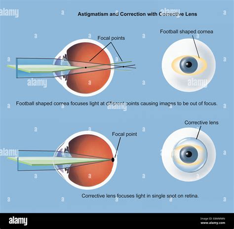 Lenses To Correct Astigmatism at Nadine Boeding blog