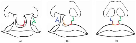 What We Learned from Performing the Inverse Malek Procedure to Repair ...
