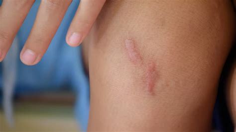 Keloids: Why Some Scars Keep Growing and How to Treat Them | OnlyMyHealth