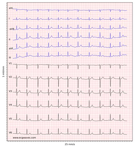 ECG interpretation: Characteristics of the normal ECG (P-wave, QRS ...