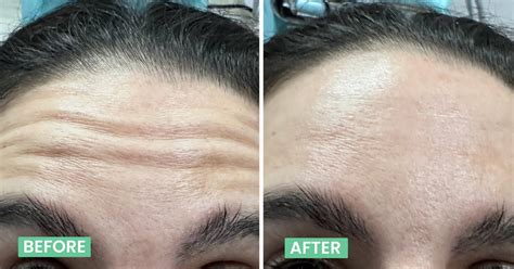 Botox Treatment in Bangalore For Wrinkles & Anti Ageing