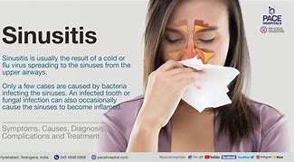 Image result for Sinus Infection Treatment
