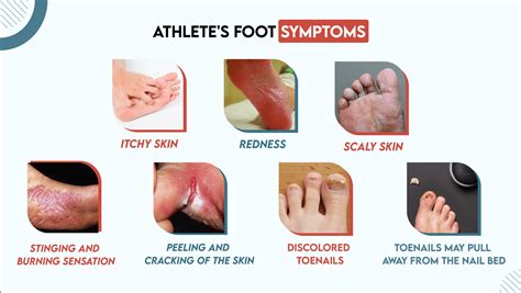 Athletes Foot Moderate Severe Case Athletes Foot Tinea Stockfoto