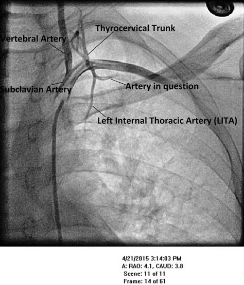Thyrocervical Trunk